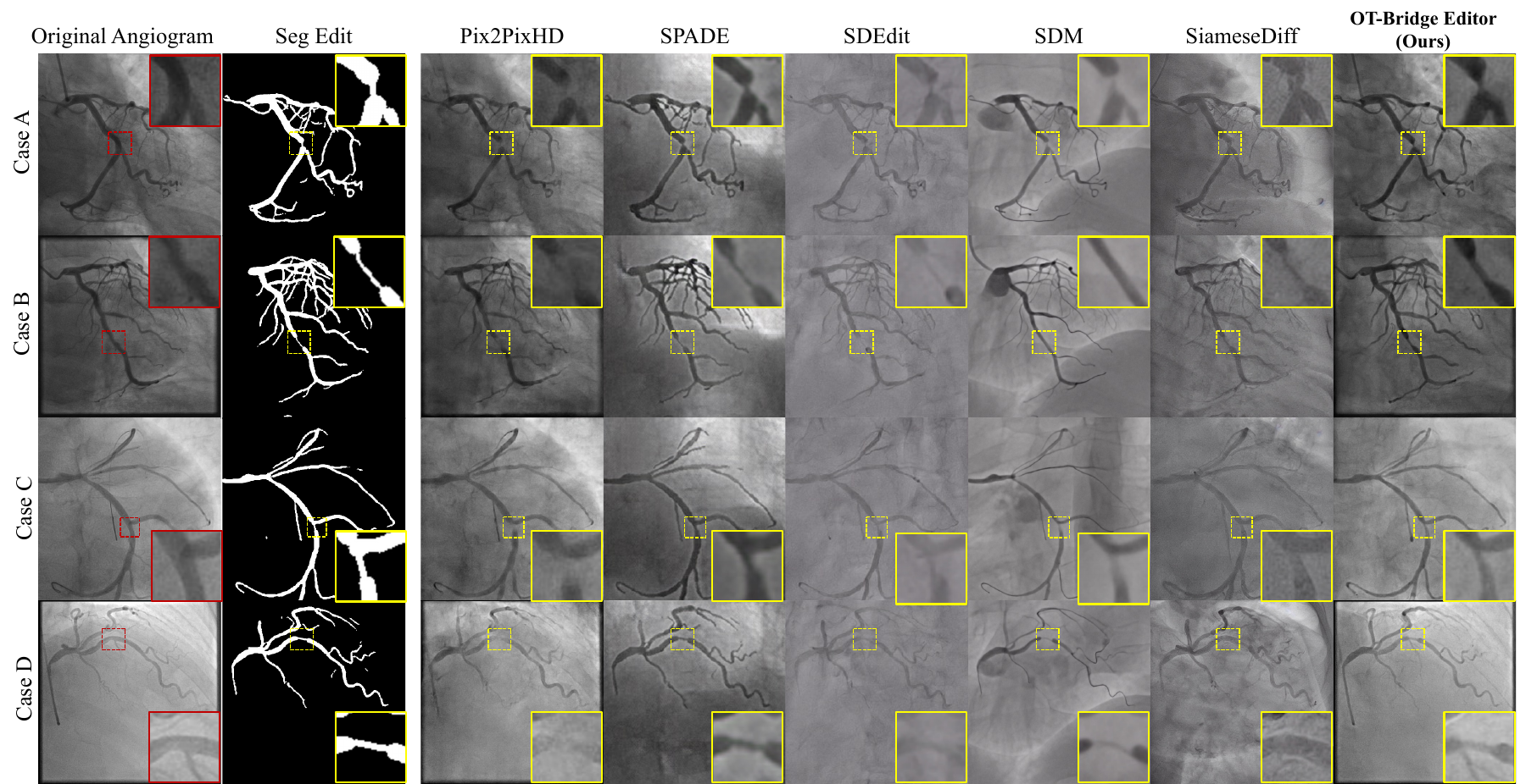 Original angiograms, target masks, baseline synthesis results, and OT-Bridge Editor outputs with enlarged target regions.