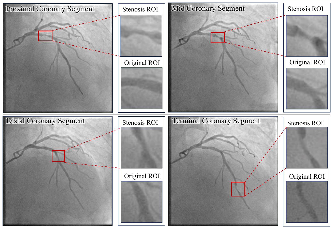 Proximal, mid, distal, and terminal edits with separate original and edited region-of-interest enlargements.